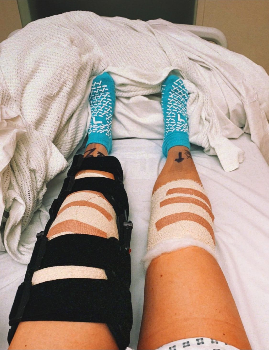 acl surgery